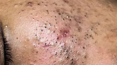 blackheads 2021 new videos|2021 newest old blackhead popping.